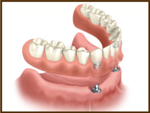 implanturi dentare