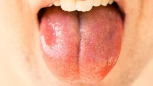 simptome candidoza bucală